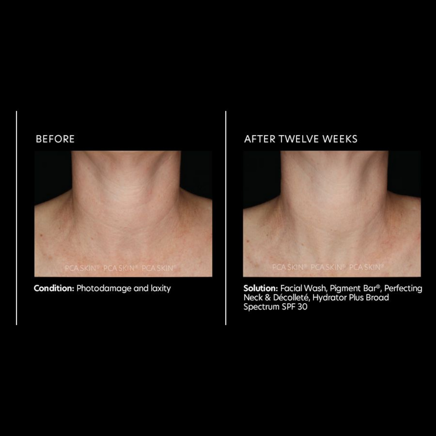 Perfecting Neck and Décolleté | PCA Skin